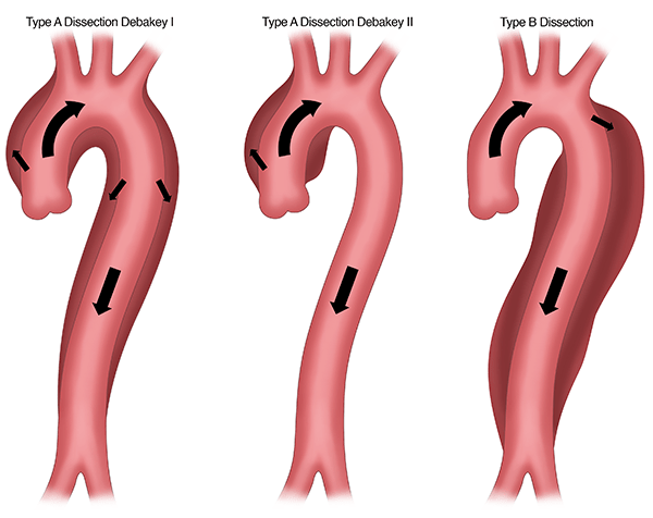 Aortic dissection is a tear in the inner layer of the aorta. Type A aortic dissection is the most common type of dissection and occurs closer to the heart. It can be life threatening and requires immediate surgical itervention to repair or replace the segment of the aorta where the tear began.