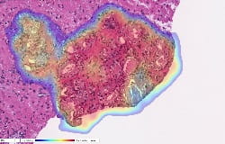 Dhir prostate heatmap release