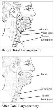 total laryngectomy laryngectomy