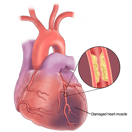 Coronary artery disease is blockage of the blood vessels that supply the heart muscle, caused by build up of plaque.