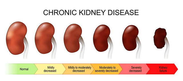 Chronic Kidney Injury Diagram Illustration Renal System