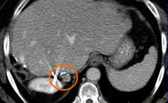 2 months post-cyberknife