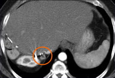 6 months post-cyberknife