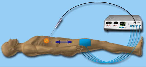 Images of Thermal Radiofrequency Ablation (RFA) of Liver