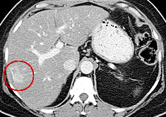 Distorted Rfa Scan Ut Images of Thermal Radiofrequency Ablation (RFA) of Liver Tumors
