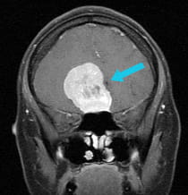 olfactory groove meningioma surgery using eea upmc