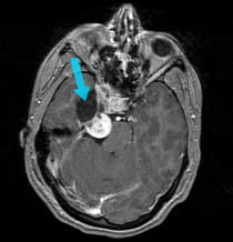 Trigeminal Schwannoma Surgery Using EEA | UPMC