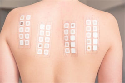 Skin Patch Testing at UPMC