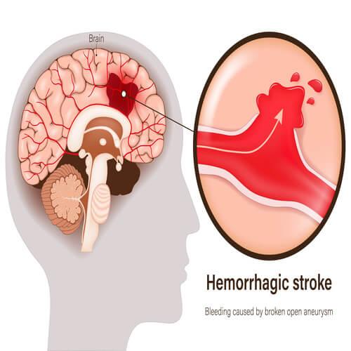 Image of aHemorrhagic stroke in the brain with bleeding caused by broken open aneurysm.